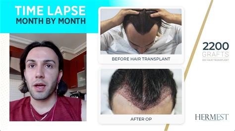 hermest hair clinic reviews|hermest hair transplant reviews.